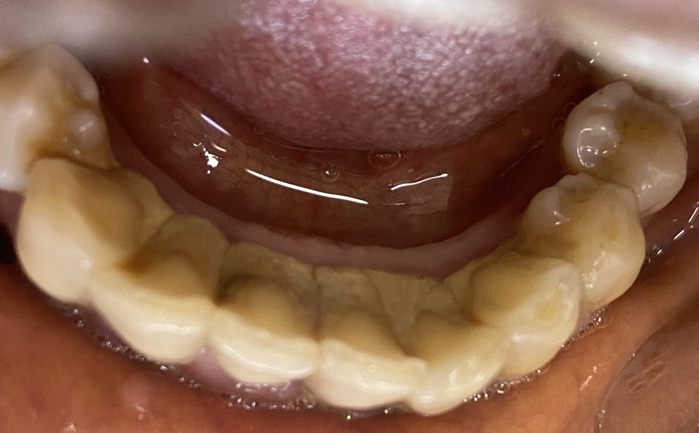 An of teeth with dental plaque and calculus