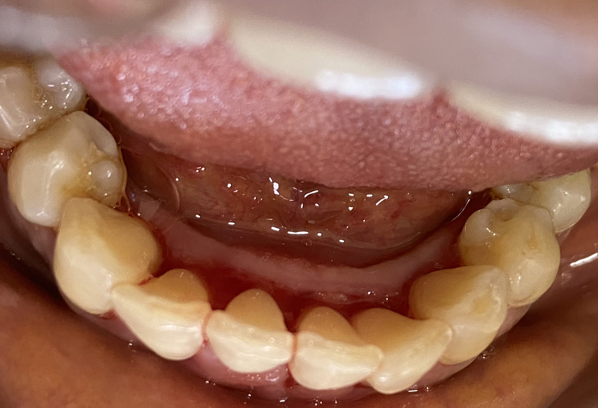 An image showing the professionally dental-cleaned adult lower teeth