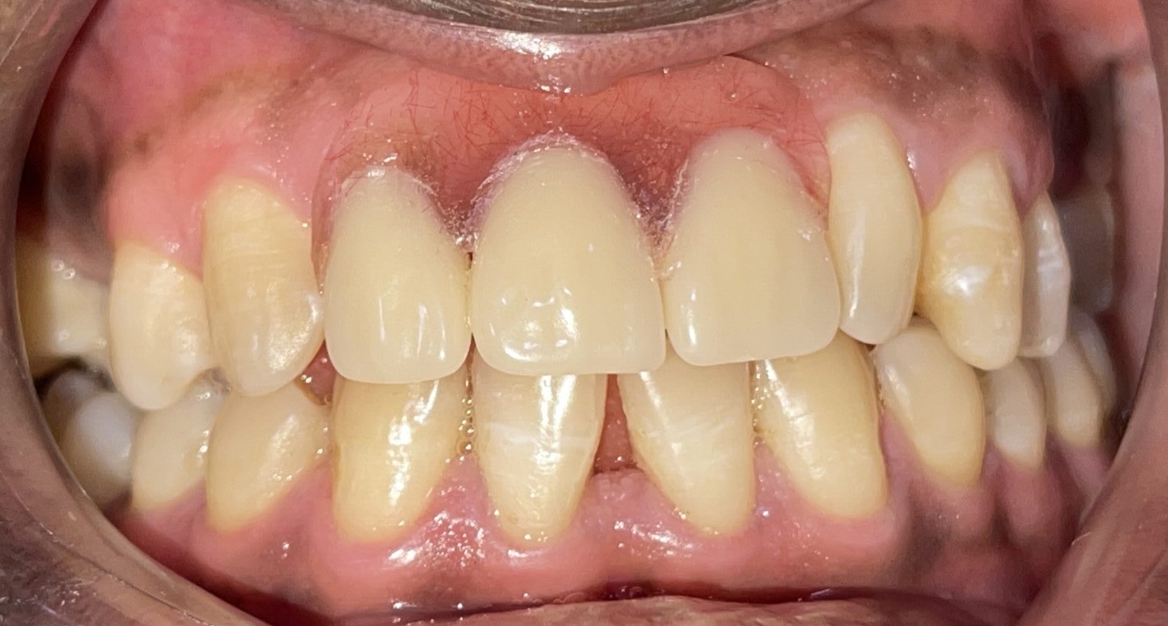 An image of a partial denture restoration