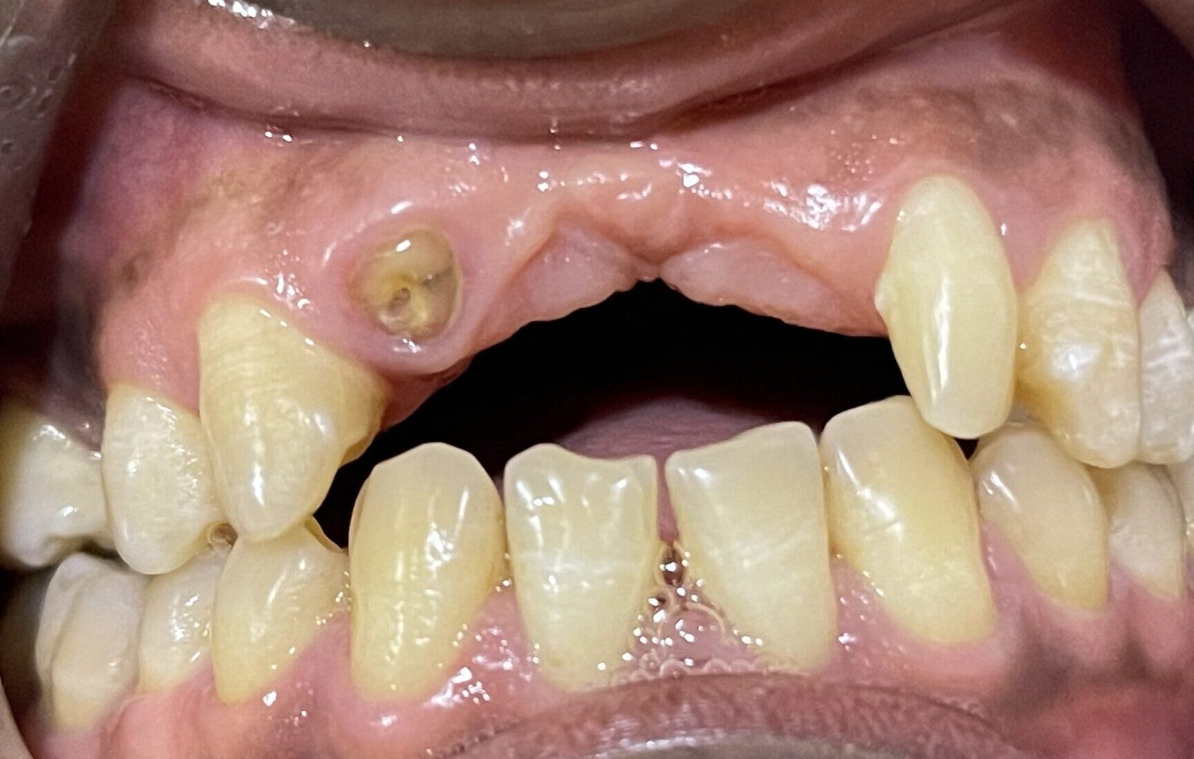 An image of missing front teeth