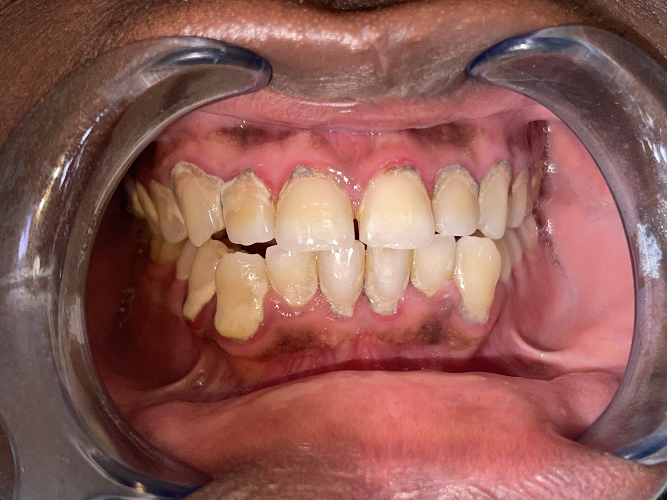 An image showing stained teeth