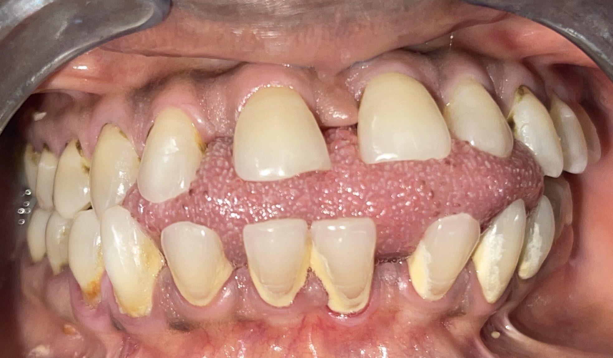 An image of the upper and lower teeth with stained dental plaque and calculus
