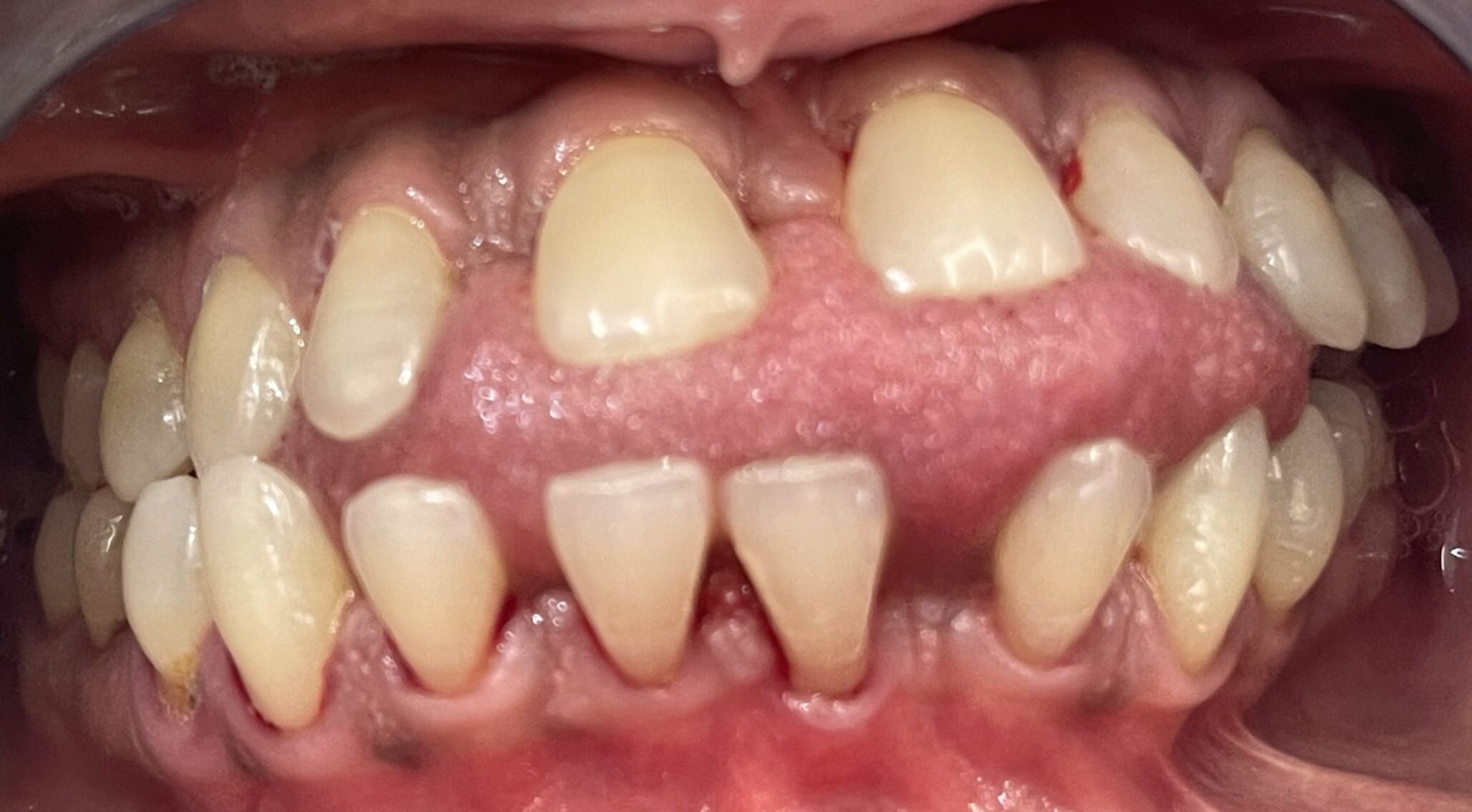 An image showing the upper and lower adult teeth after a professional dental cleaning