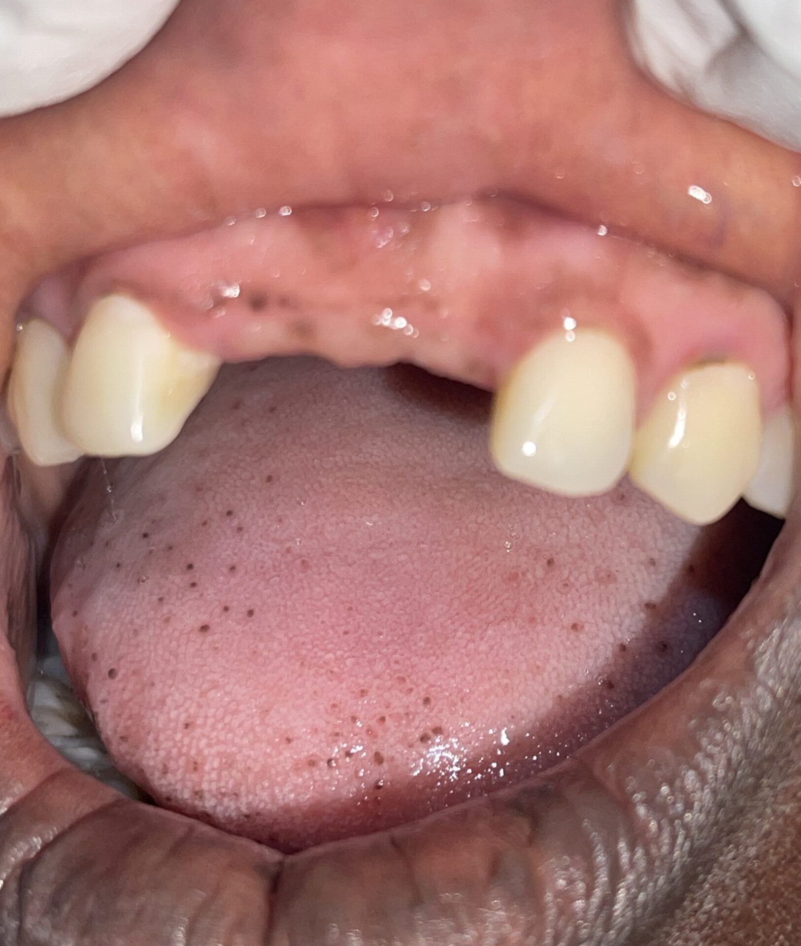 An image of missing front teeth