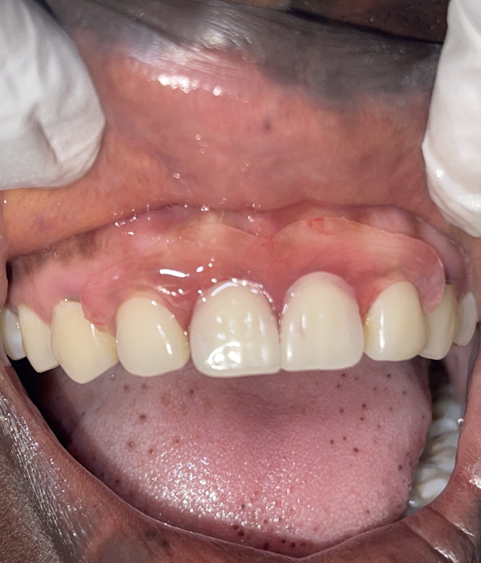 A patient with a partial denture restoration