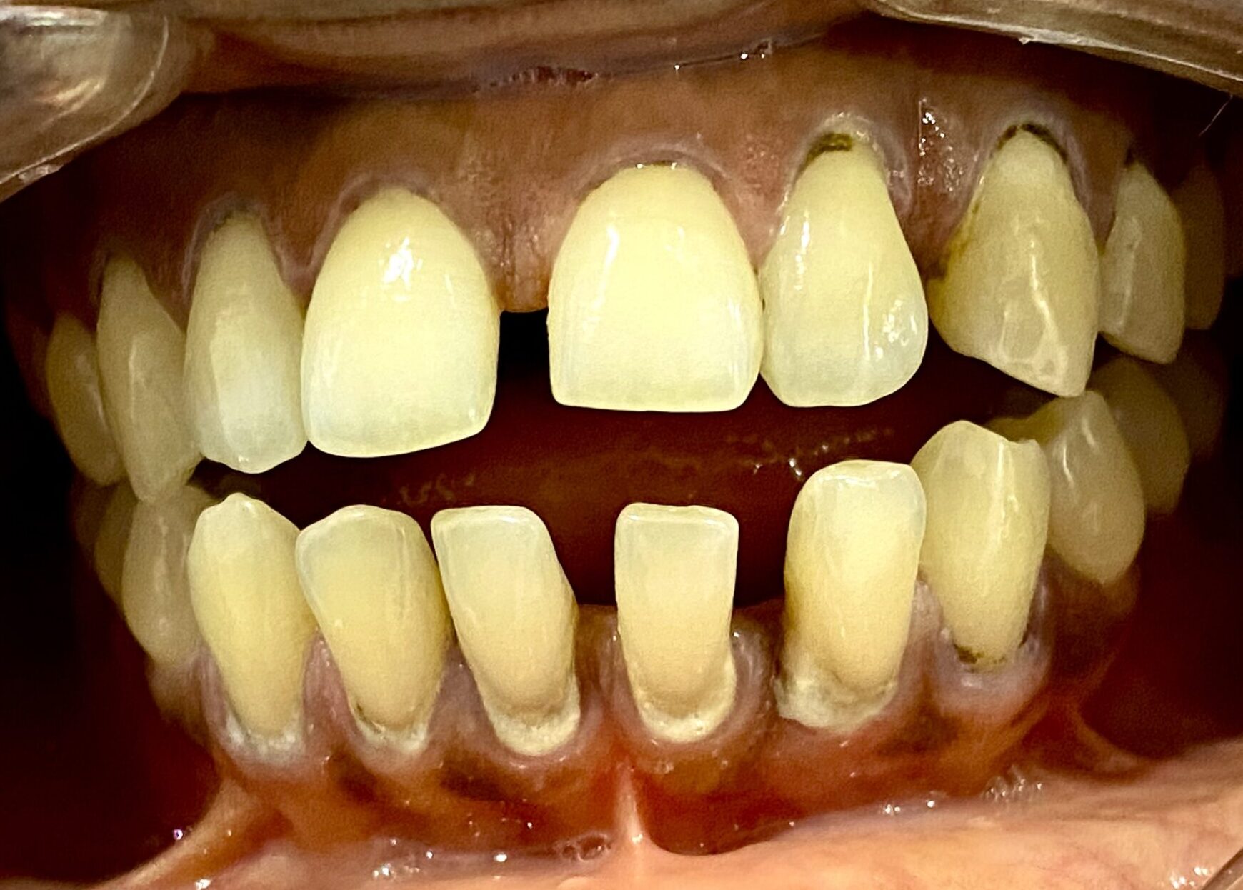 An image of teeth with dental plaque and calculus