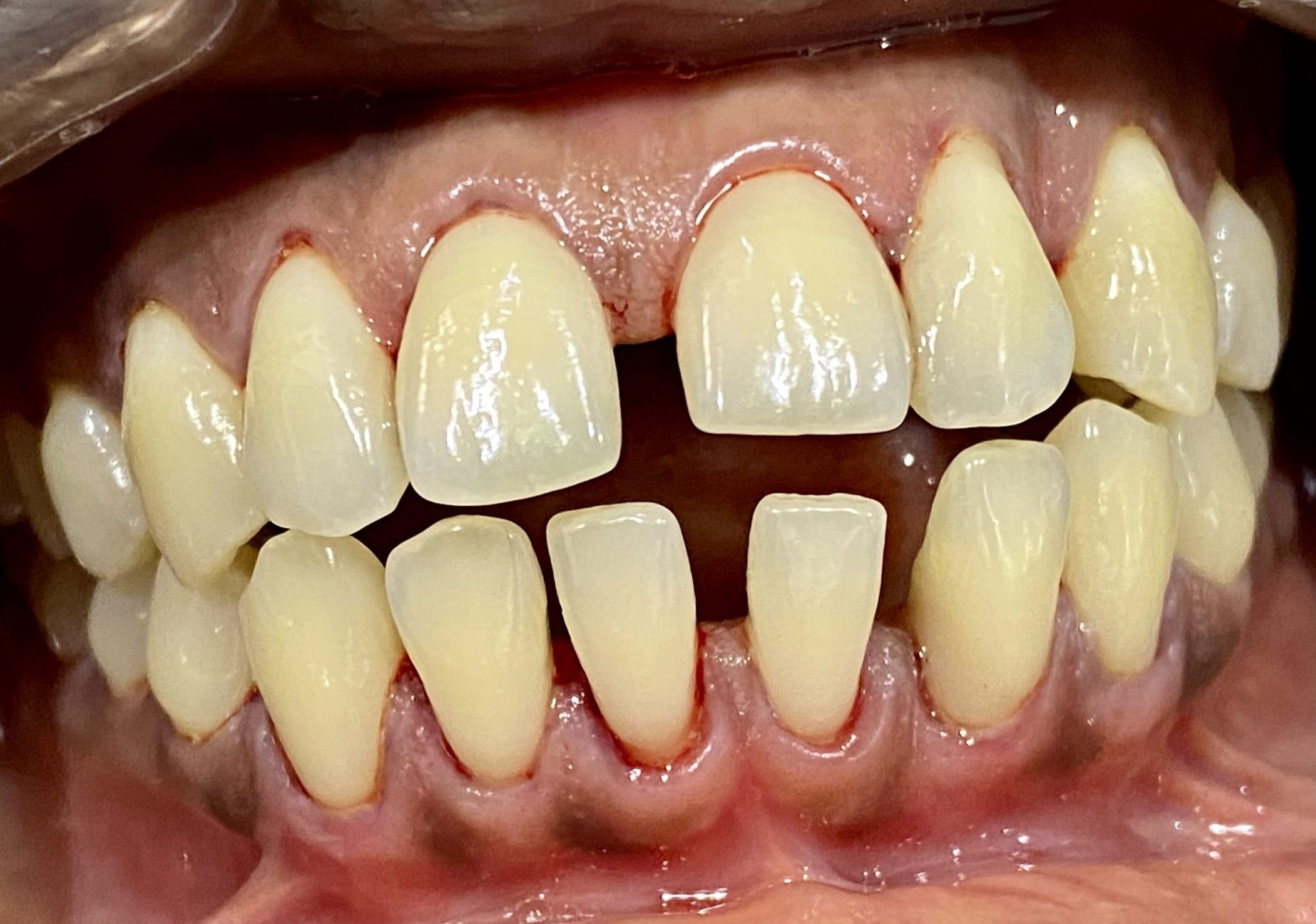 An image of teeth without plaque and calculus