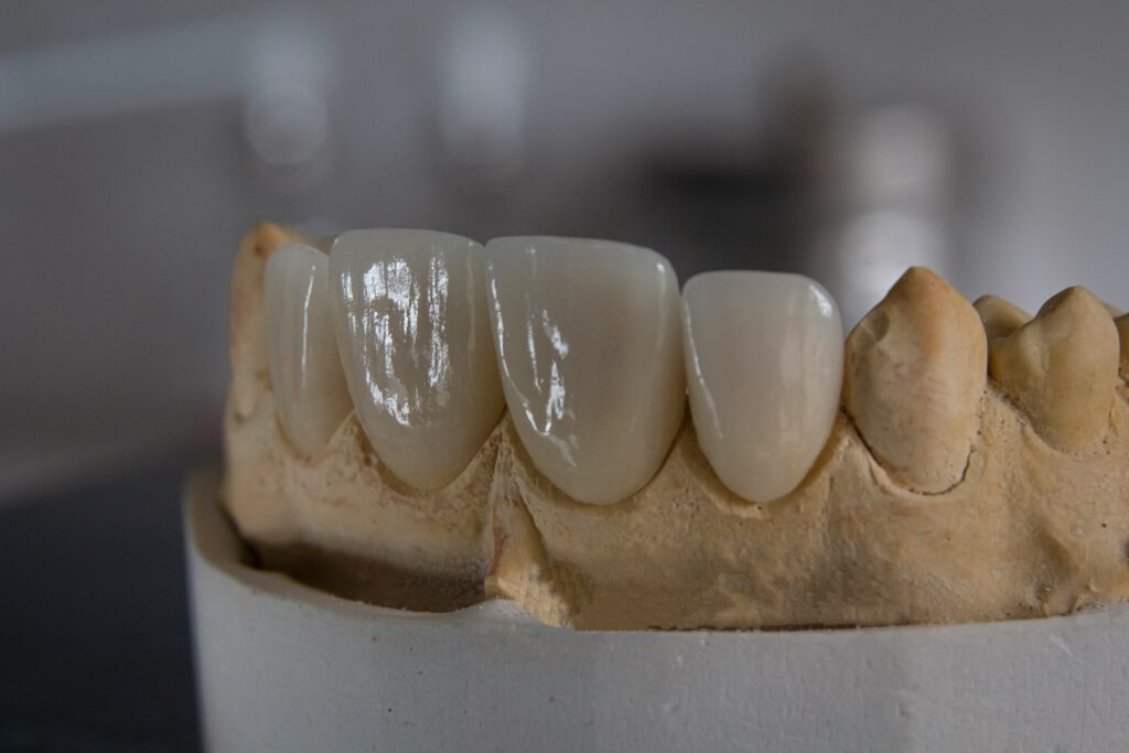 A dental bridge