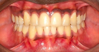 corrected overcrowding after braces