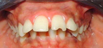 An image showing class 2 malocclusion