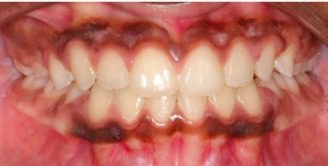 Class 3 mal-occlusion corrected