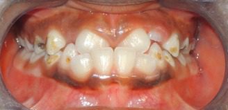 An image of class 3 malocclusion before orthodontic treatment