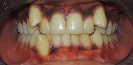 An image showing teeth crowding