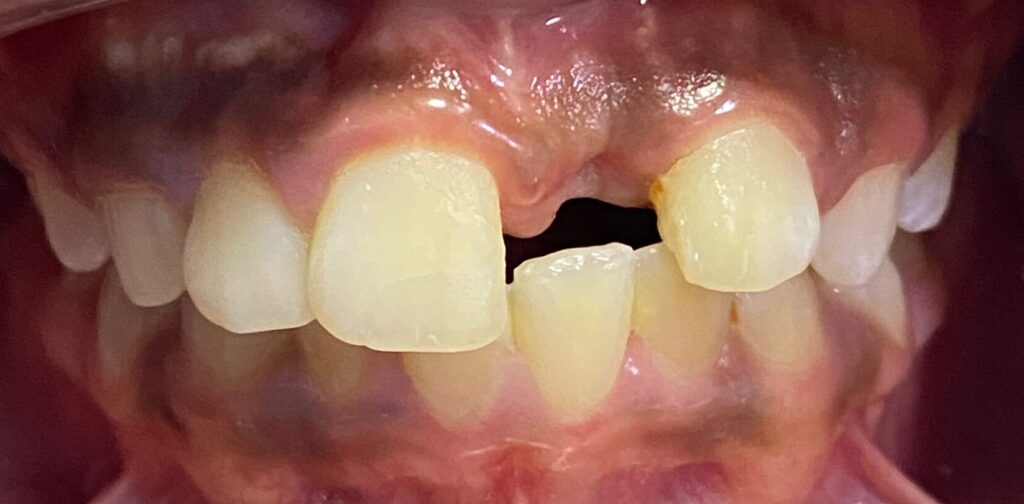 A missing front tooth before a dental bridge