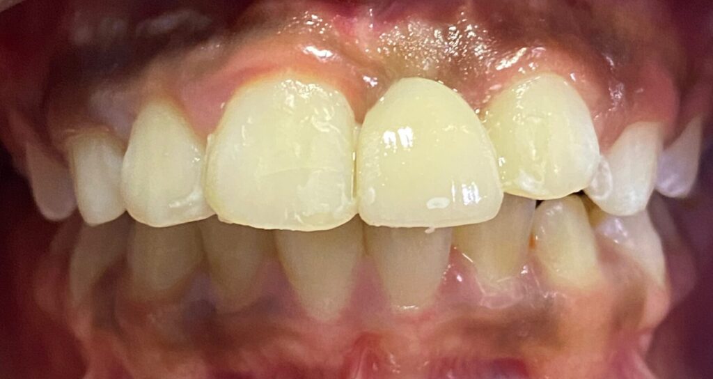 A missing upper tooth replaced with a dental bridge